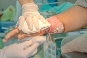 What Complications Arise from Severe Burn Injuries?